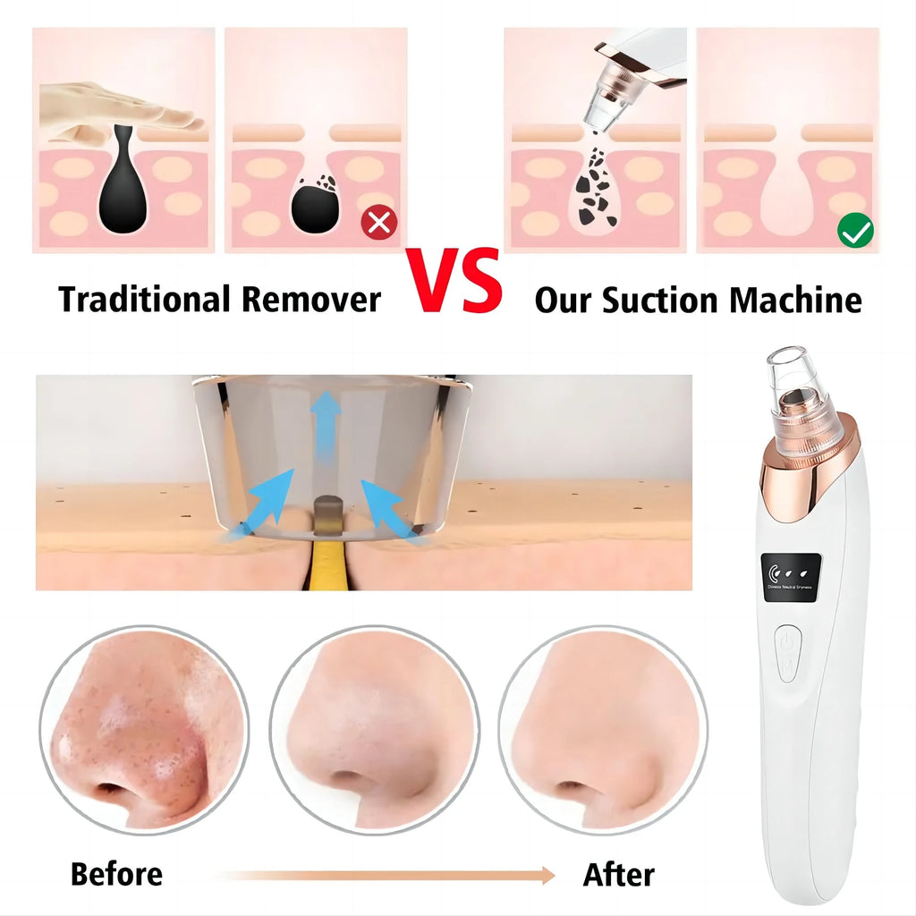 Electric Blackhead Remover Vacuum Cleaner